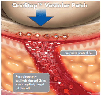 OneStop Vascular Pre-Slit Technology
